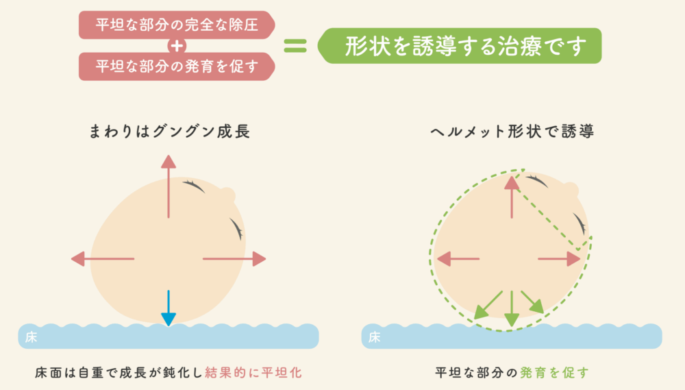 ヘルメット治療